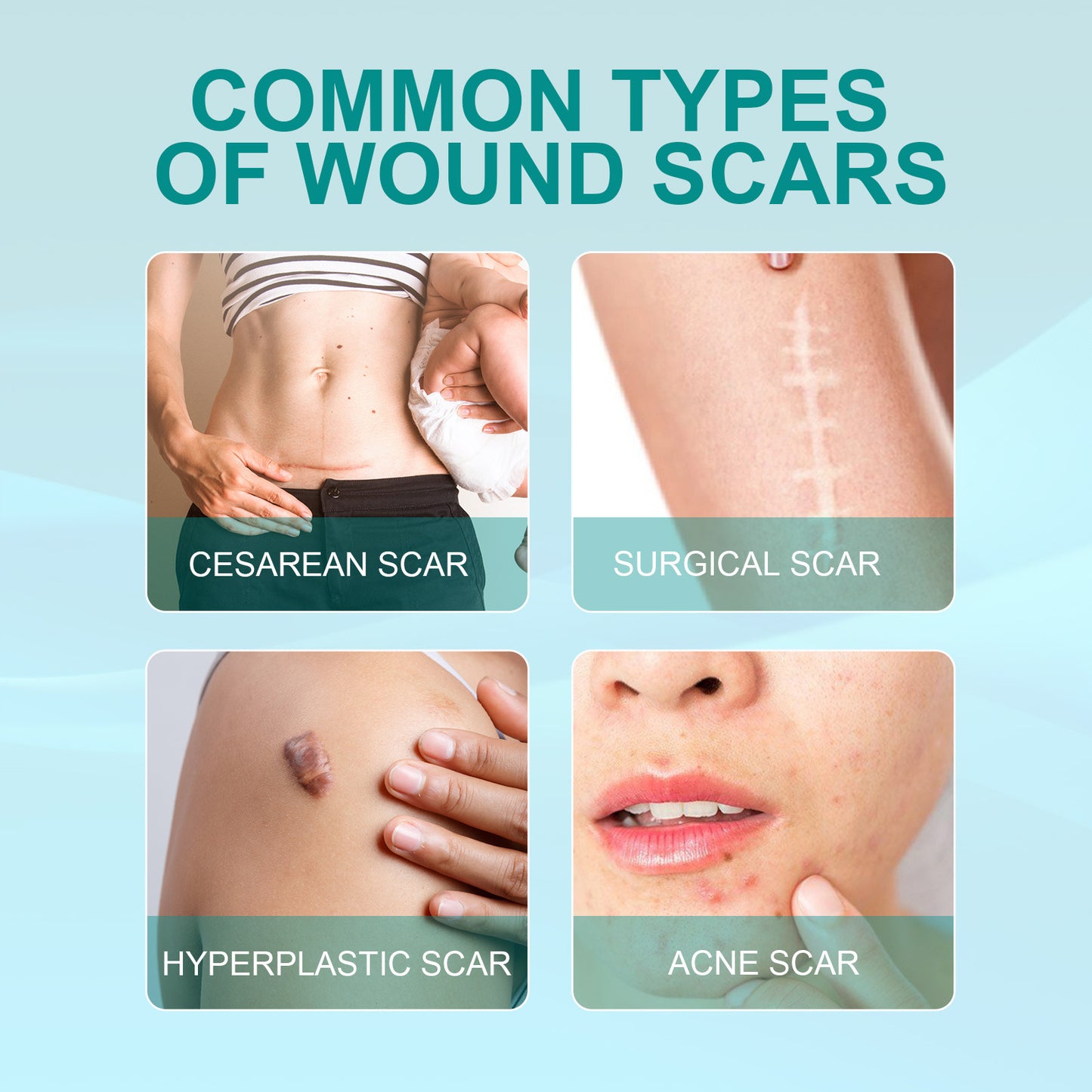 ScarRemove - Surgical Scar Smoothing Skin Care Spray